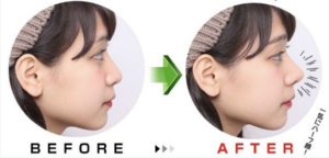 今話題の鼻アイプチ「ノーズシークレット」